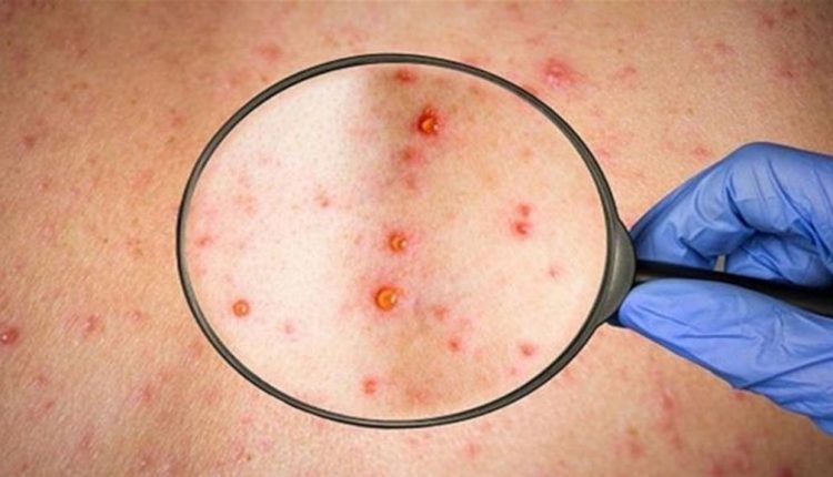 جدري القرود